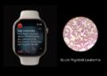 Apple Watch ช่วยให้สาวรายหนึ่ง รอดชีวิตจากมะเร็งเม็ดเลือดขาวชนิดเฉียบพลัน