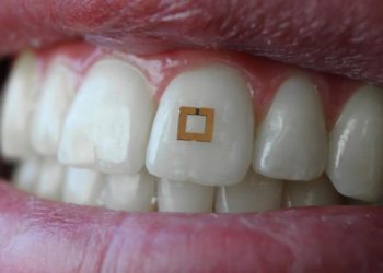 ทีมวิจัยคิดค้นอุปกรณ์สวมใส่ขนาดเล็ก ยึดติดกับฟัน ช่วยตรวจสอบอาหารหรือเครื่องดื่มที่คุณทาน รวมถึงการสูบบุหรี่