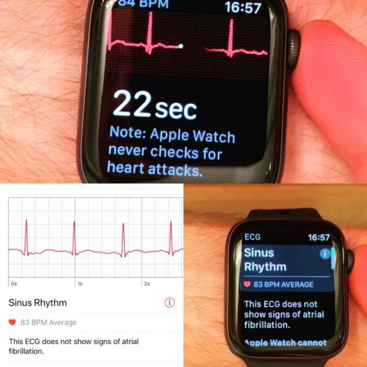 5 สิ่งที่ต้องรู้เกี่ยวกับแอพพลิเคชั่น ECG (Electrocardiogram) บน Apple Watch
