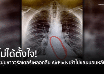 ไม่ได้ตั้งใจ! หนุ่มชาววุร์สเตอร์เผลอกลืน AirPods เข้าไปขณะนอนหลับ!
